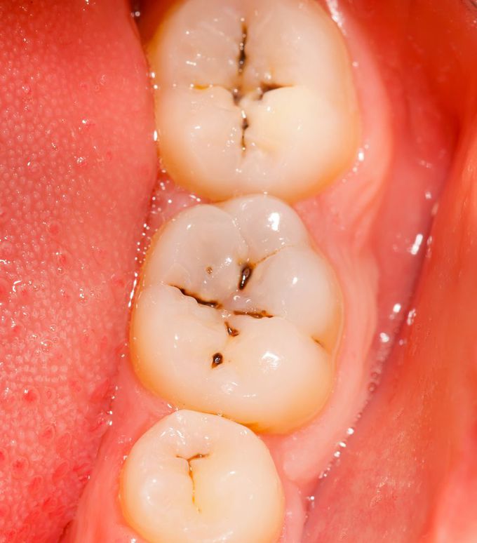 Pit and Fissure Cavities