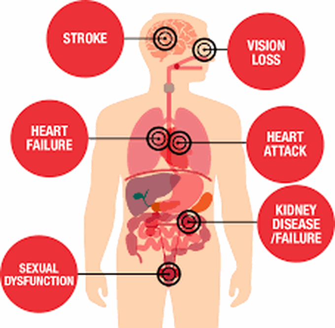 Symptoms of high blood pressure