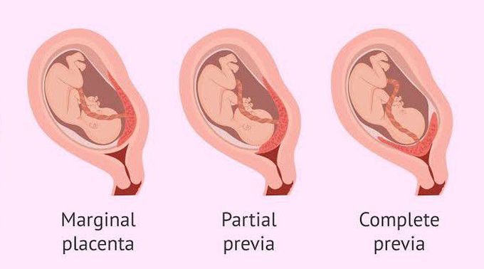 Types of Placenta previa