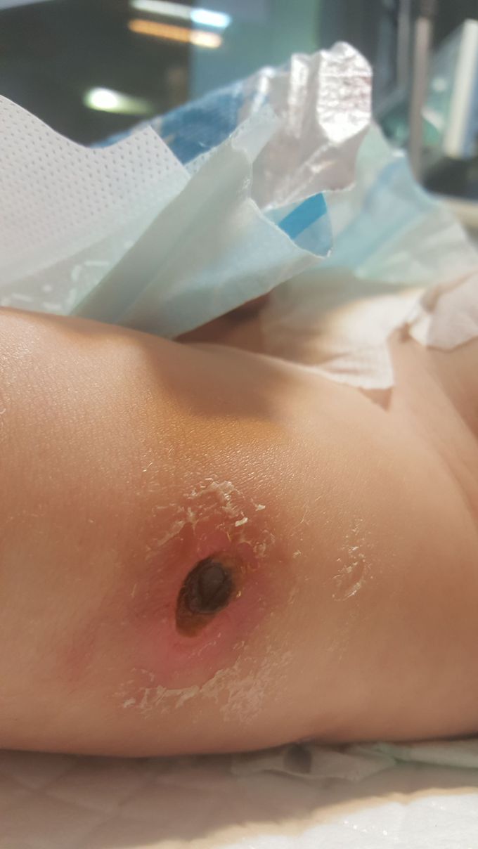 Dx? Cause?  (infant)