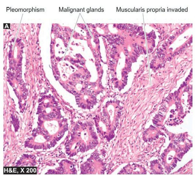 Colonic adenocarcinoma