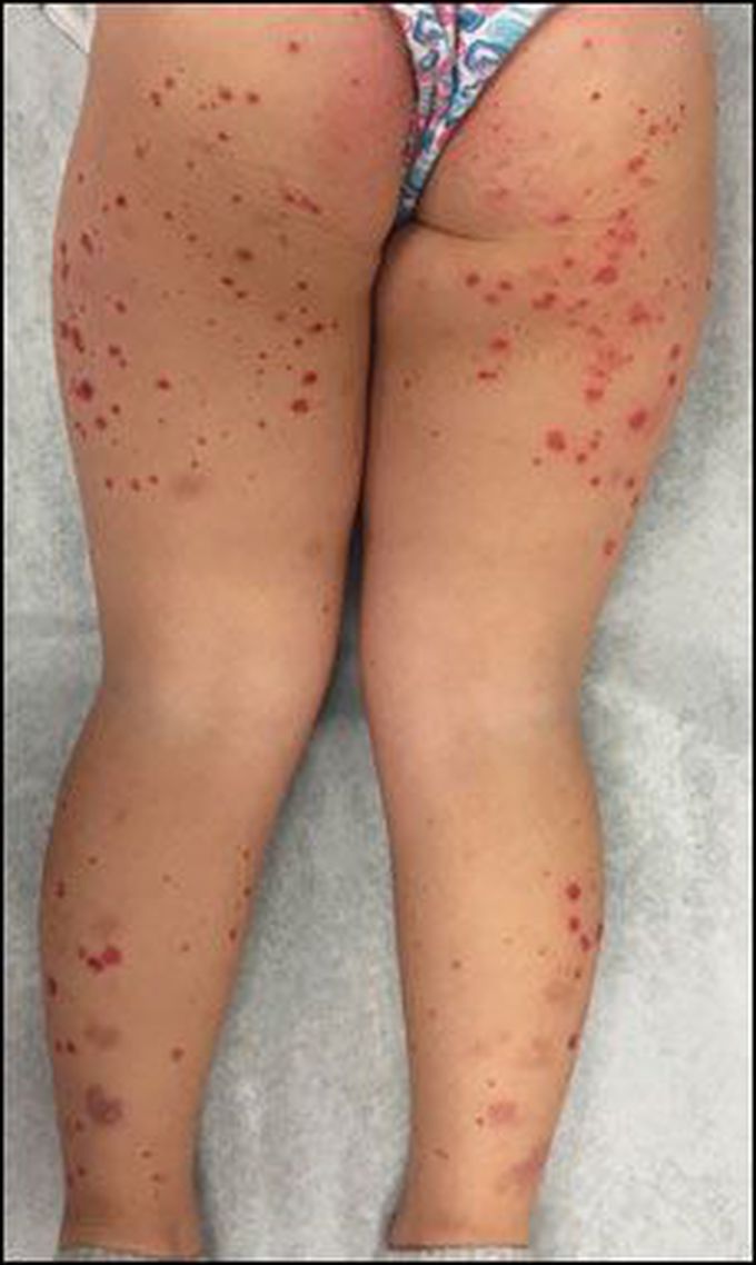 A 4-year-old girl presents with reddish, purple lesions on bilateral lower legs