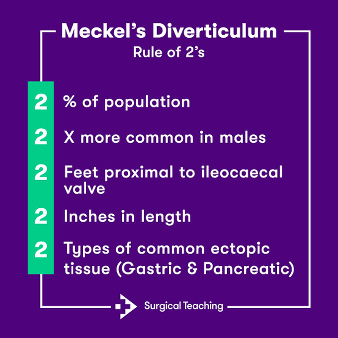 Meckel's Diverticulum rule of 2's