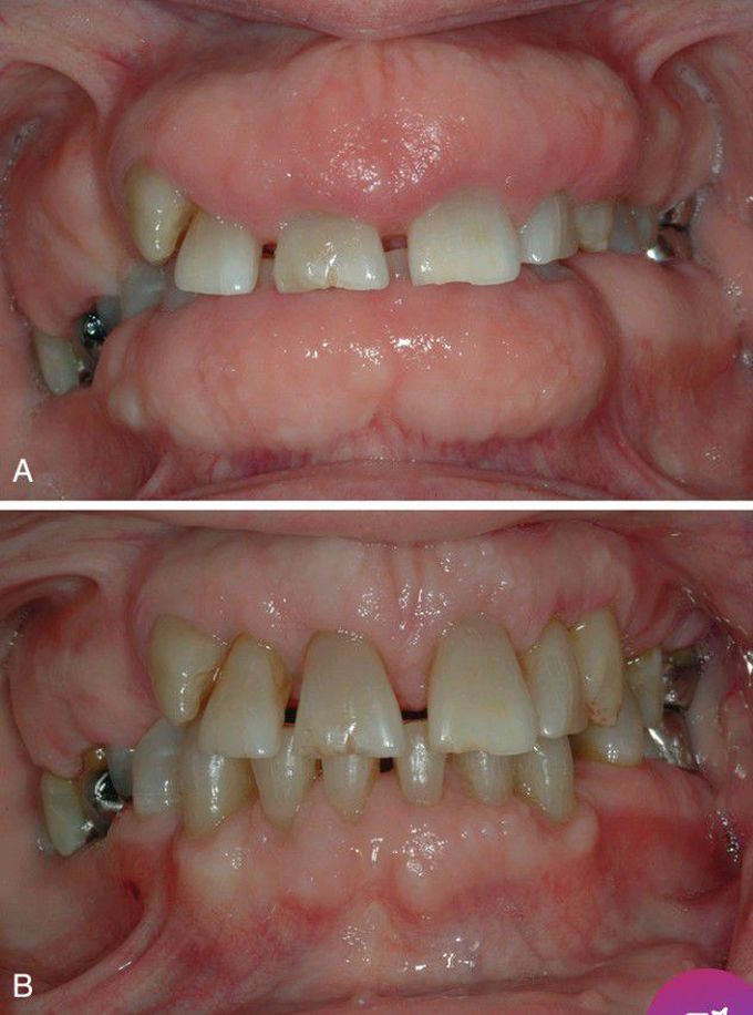 Gingival Fibromatosis