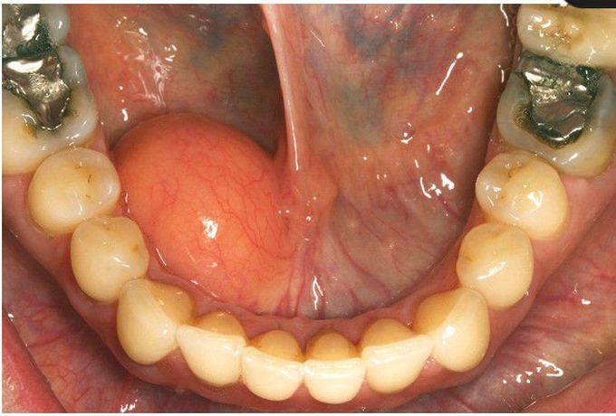 Lipoma