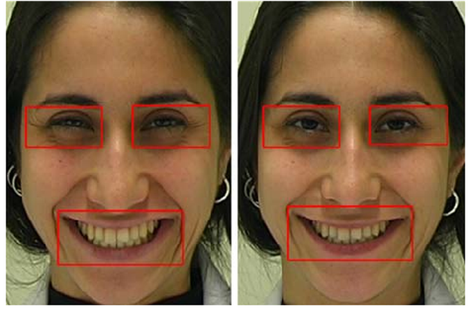 Posrd vs genuine smile