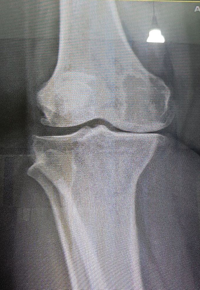 Radiological findings of osteoarthritis