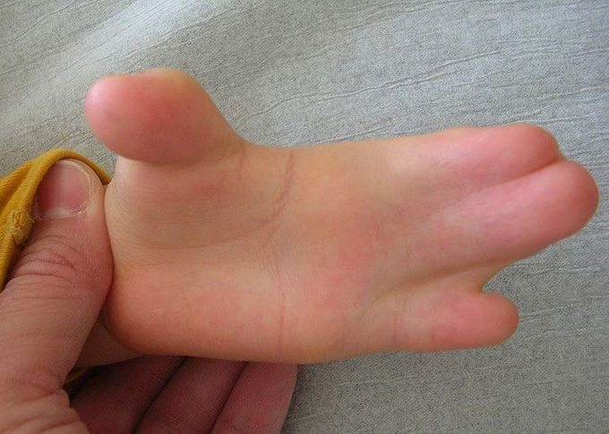 Hands in Apert syndrome with syndactyly