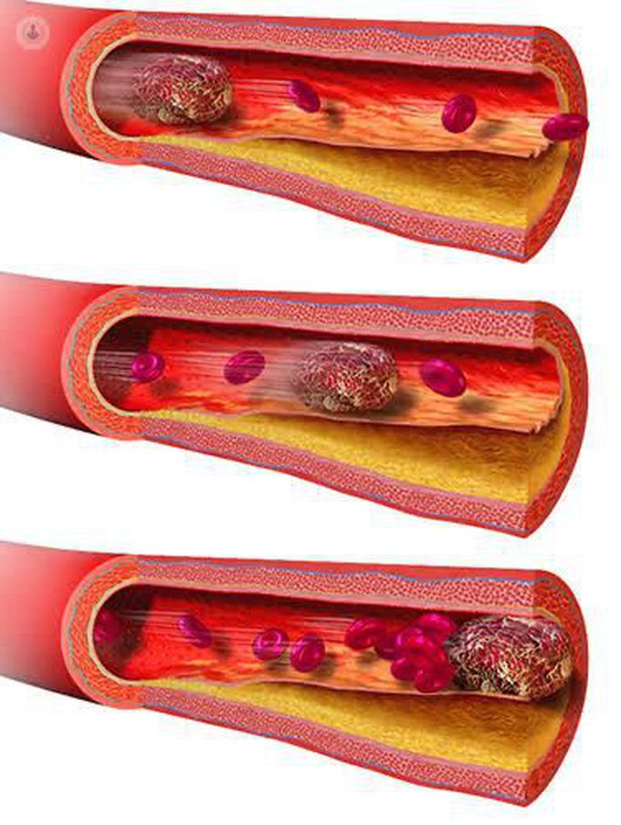 Embolism