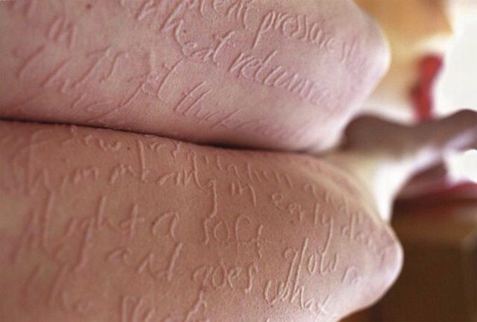 Dermatographia