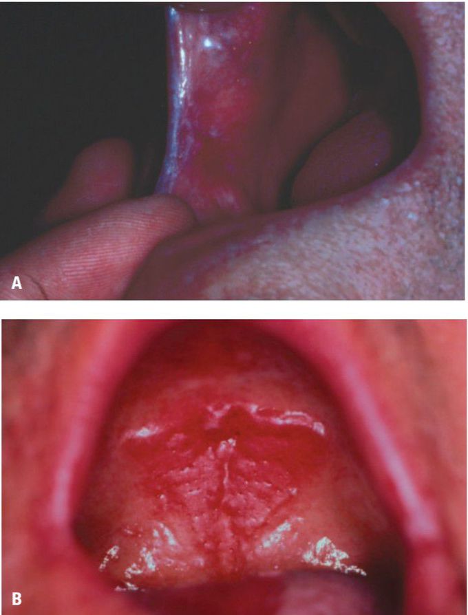 Candidal leukoplakia