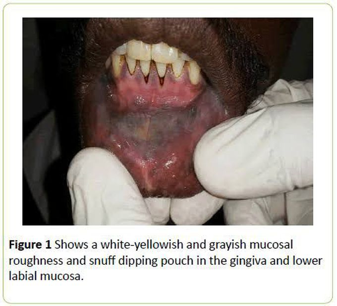 Snuff dippers lesion