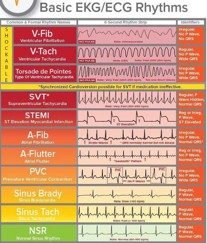 Basic EKG rhymes