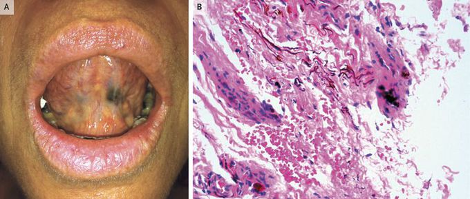 Oral Amalgam Tattoo Mimicking Melanoma