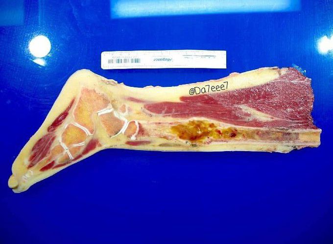 Tibial Osteosarcoma