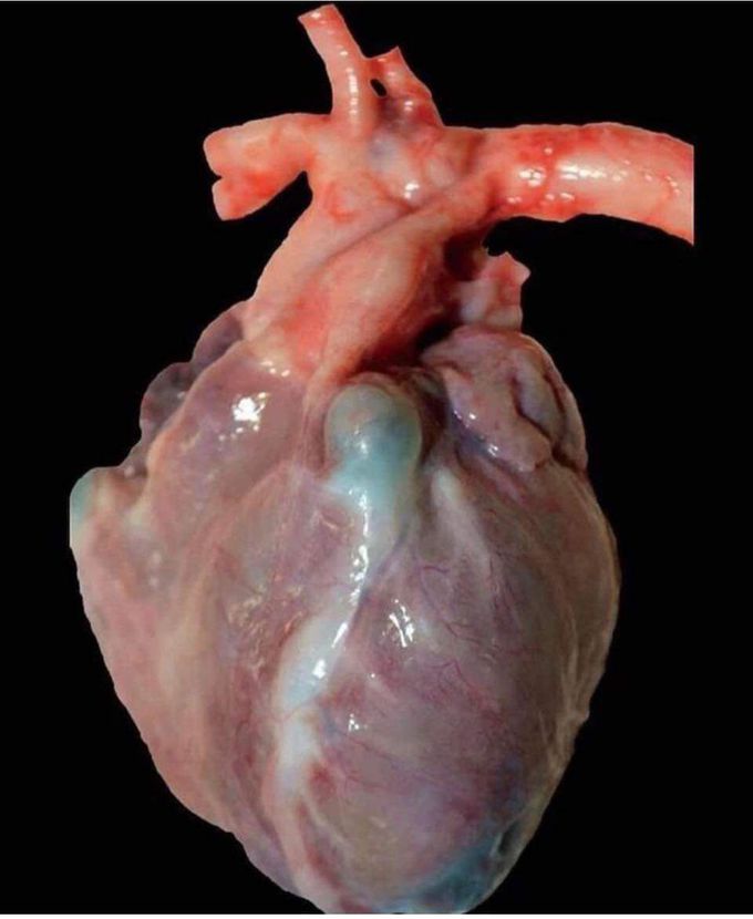 ♨️Coronary artery♨️ #Aneurysm,#Thrombosis 
Kawasaki Disease 💔