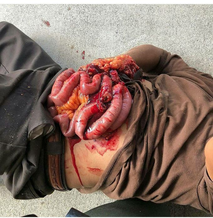 Job accident