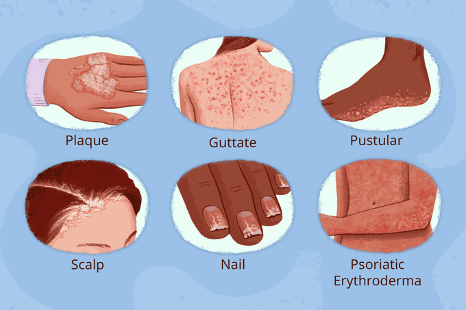 Types of Psoriasis