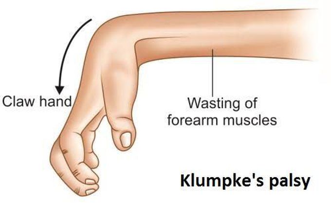 Klumpkes paralysis