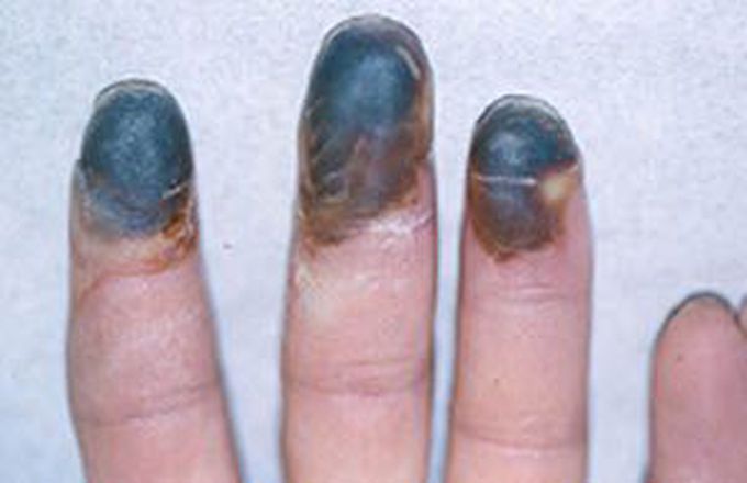 Thromboangiitis Obliterans AKA Buerger's Disease