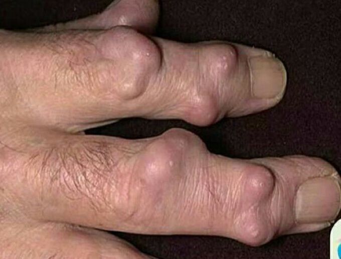 Nodule