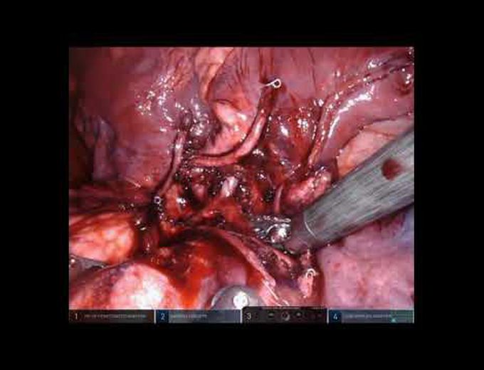 Robotic Right Lower Lobe Sleeve Resection