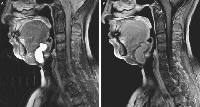 Thyroglossal Duct Cyst