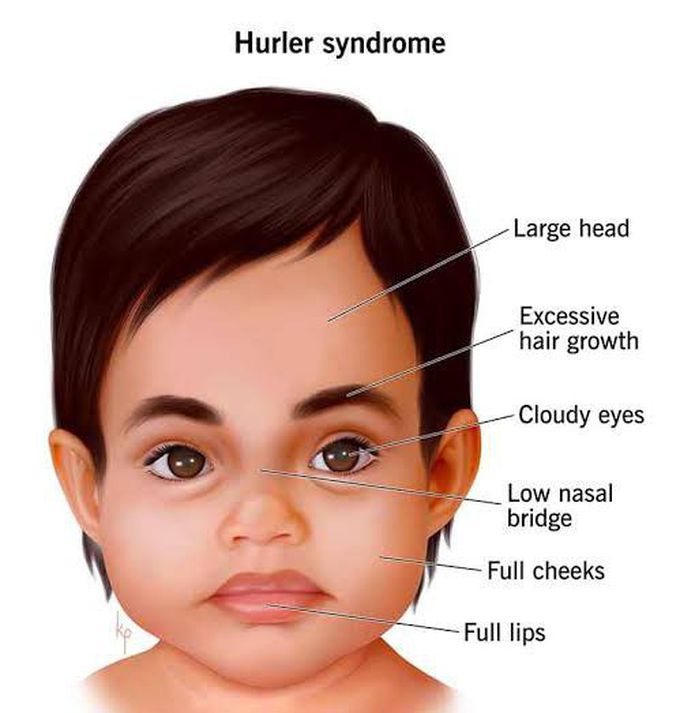 These are the symptoms of Hurler syndrome