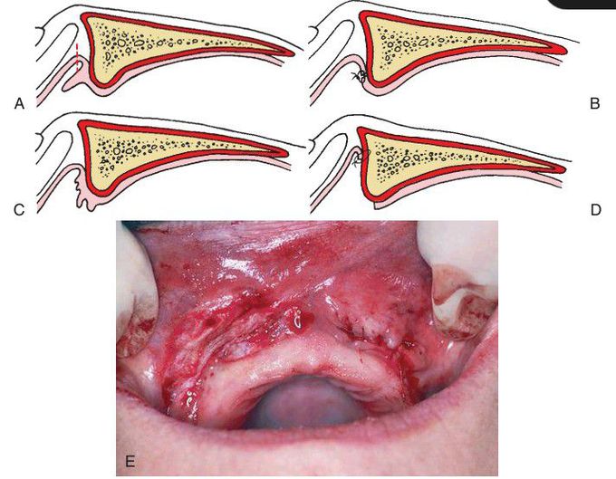 Fibrous hyperplasia