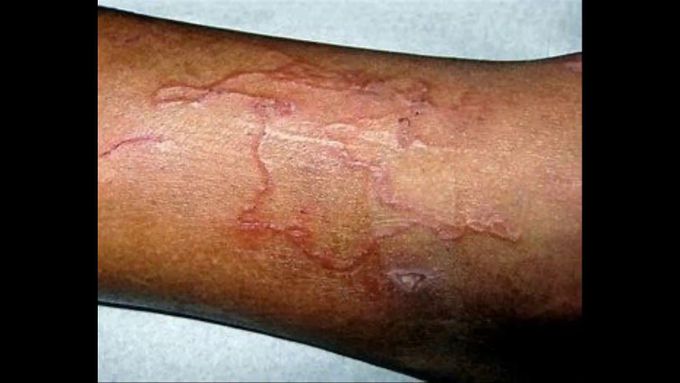 Hookworm