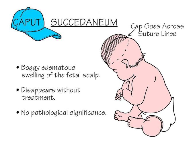 Succedaneum