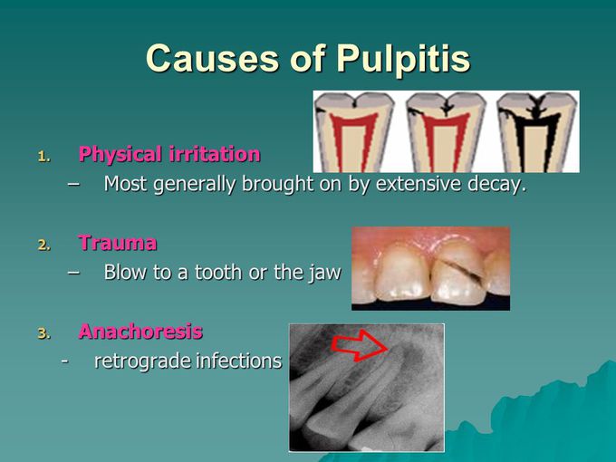 Causes of Pulpitis