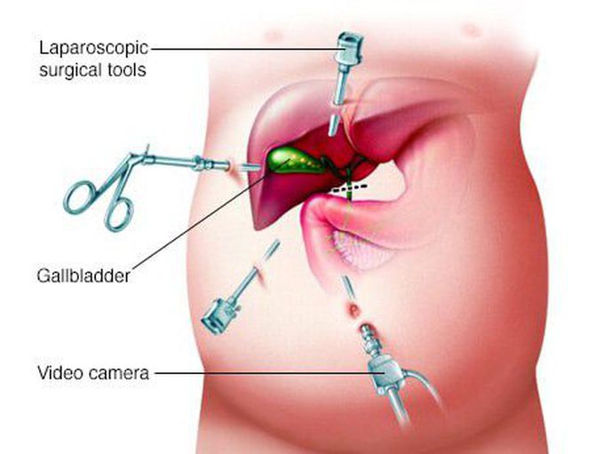 Treatment for Cholelithiasis