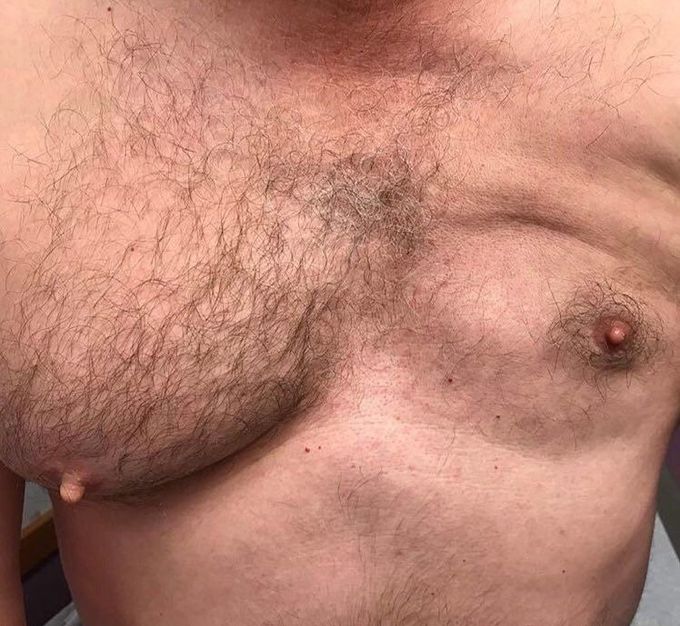 Poland syndrome