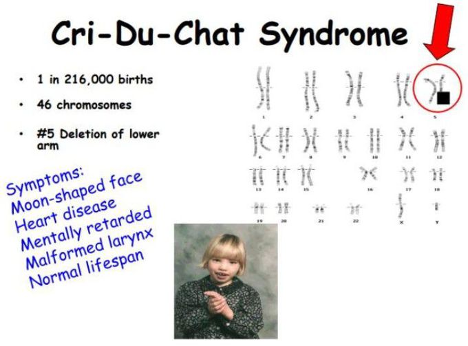 Cri-Du-chat Syndrome