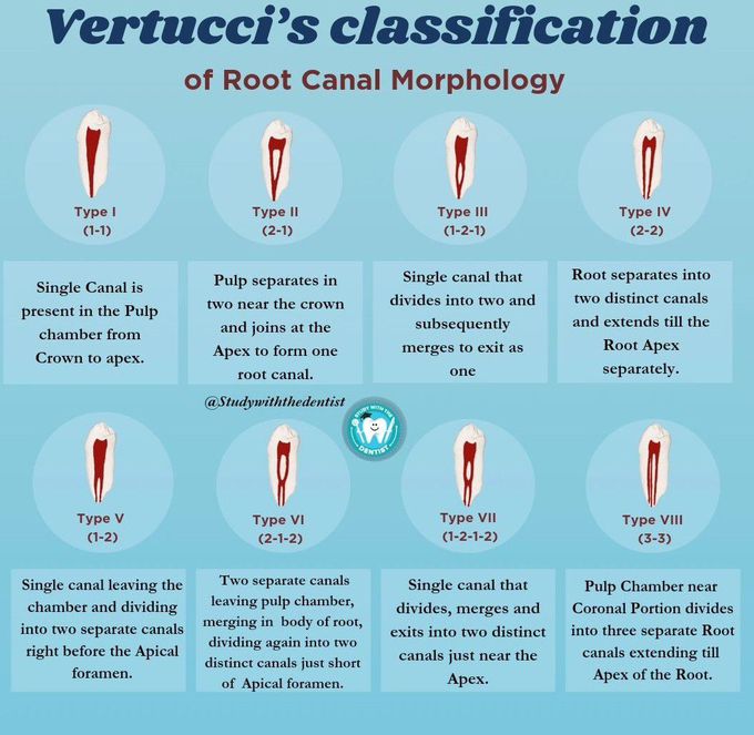 Vertucci Classification