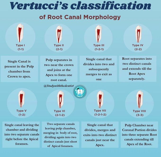 Vertucci Classification - MEDizzy