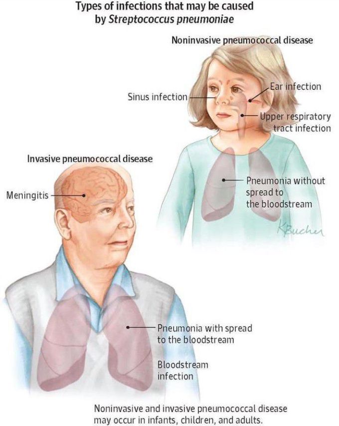 Infection caused by streptococcus pneumonia