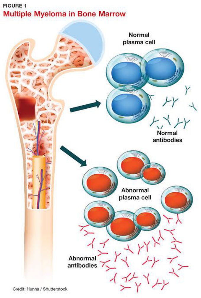 Causes of multiple myeloma