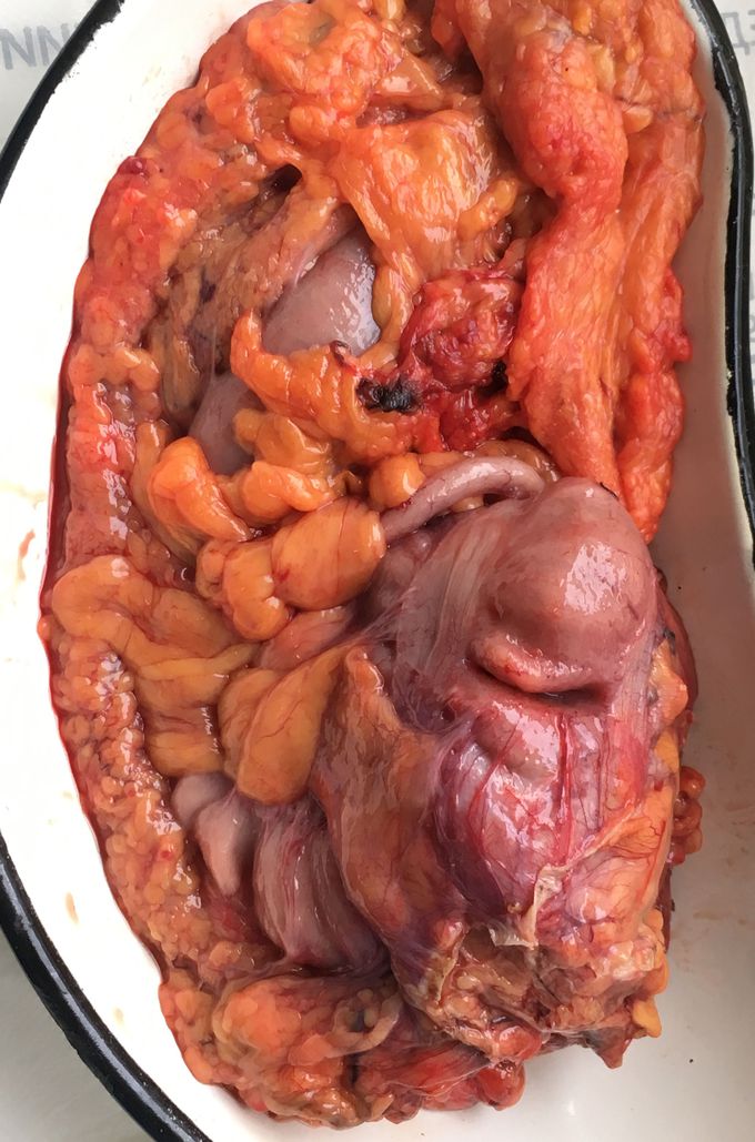 Right hemycolectomy about tumor 🔪