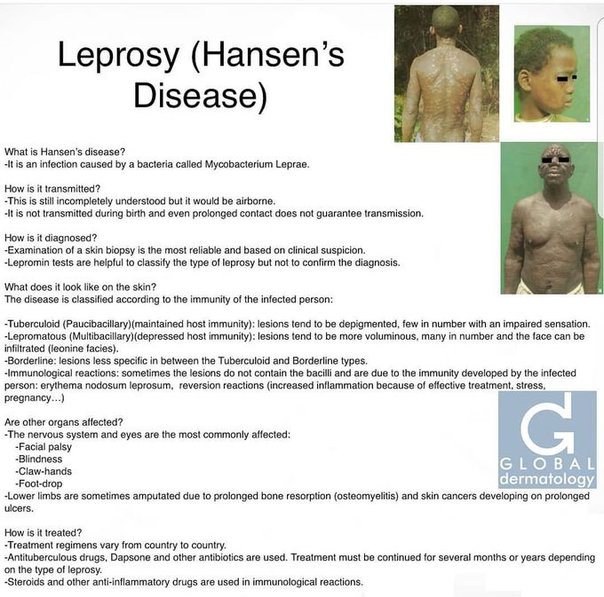 Leprosy