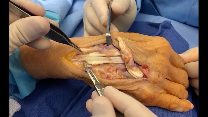 Spontaneous Extensor Tendon Rupture and Repair