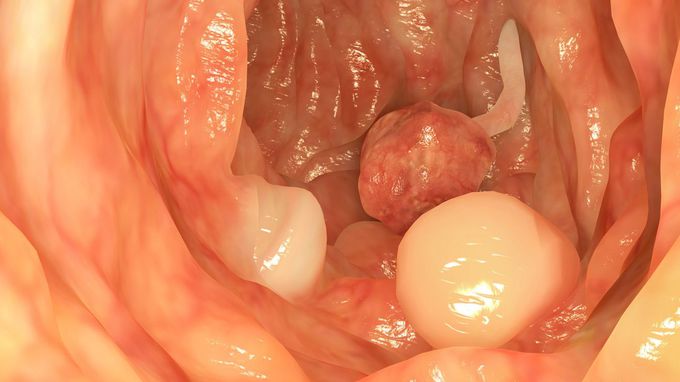 Colonic polyps