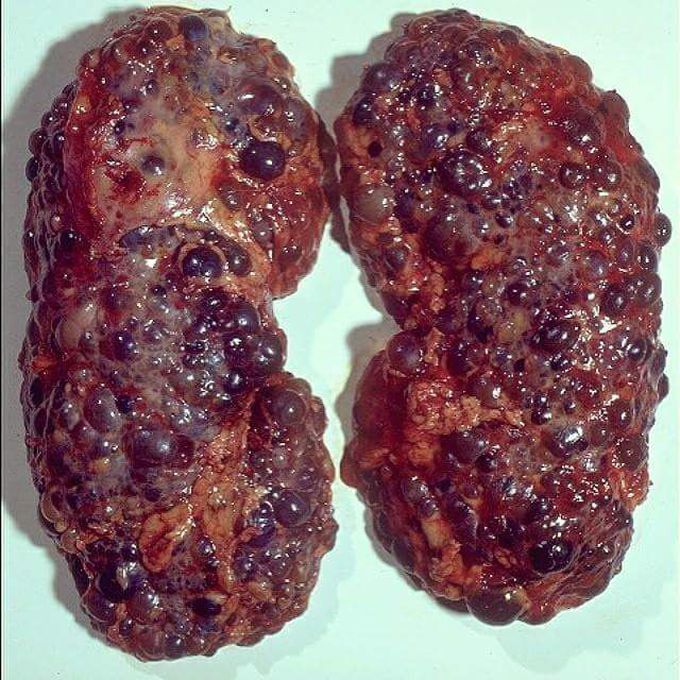 Polycystic kidney disease