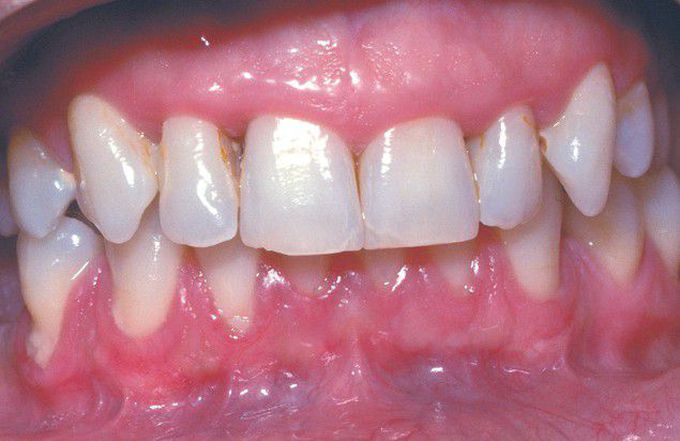 Adult Periodontitis