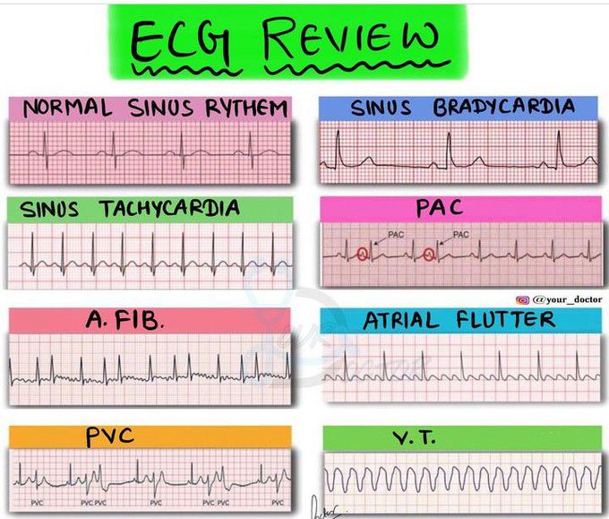 ECG Review