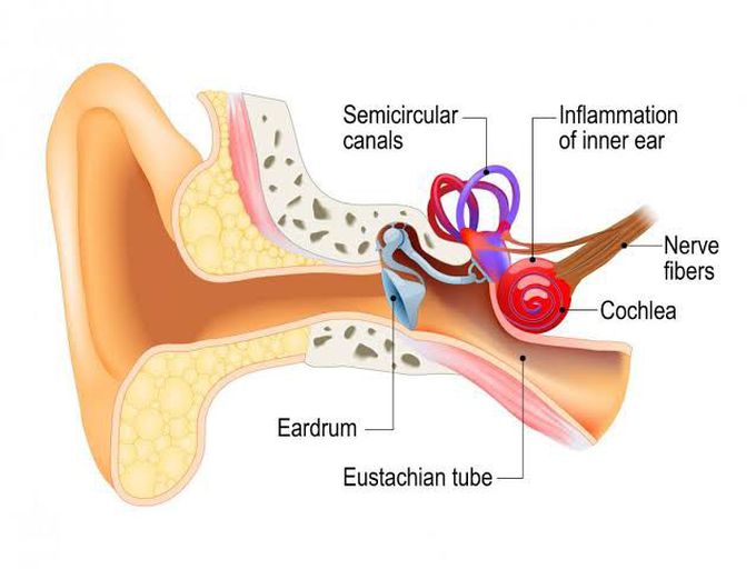 Labyrinthitis