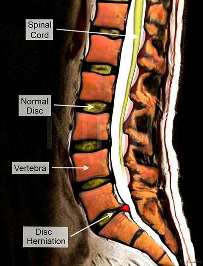 Disc herniation