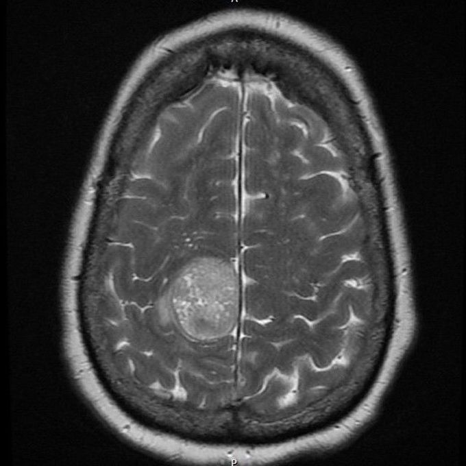 Left side parasagittal meningioma
