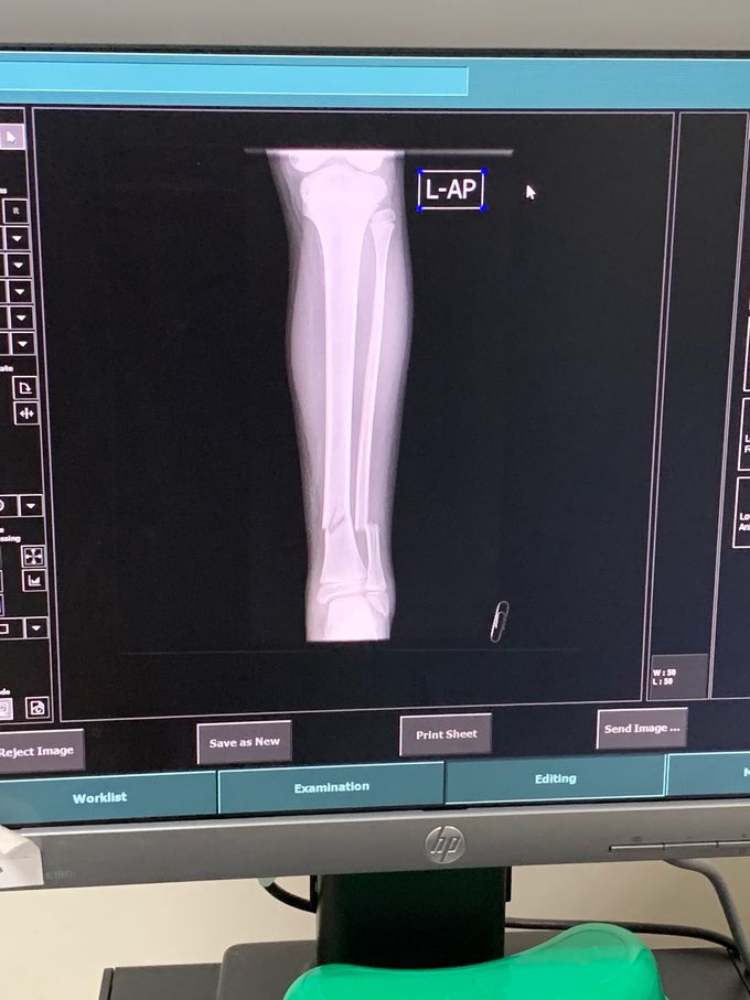 Xray of left leg AP lateral